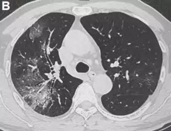 河南新冠病毒最新動態及防護步驟指南