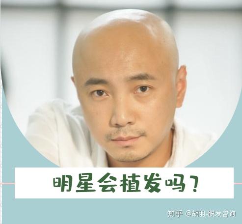 揭秘明星不植發的背后原因，溫情與陪伴的秀發故事