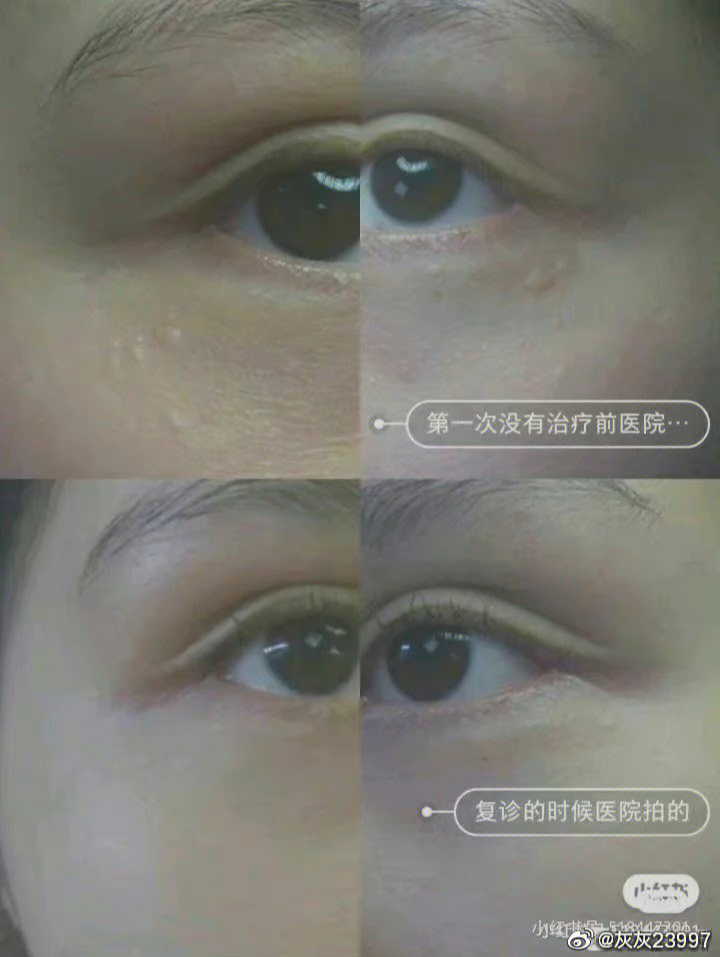 汗管瘤最新治療方法詳解