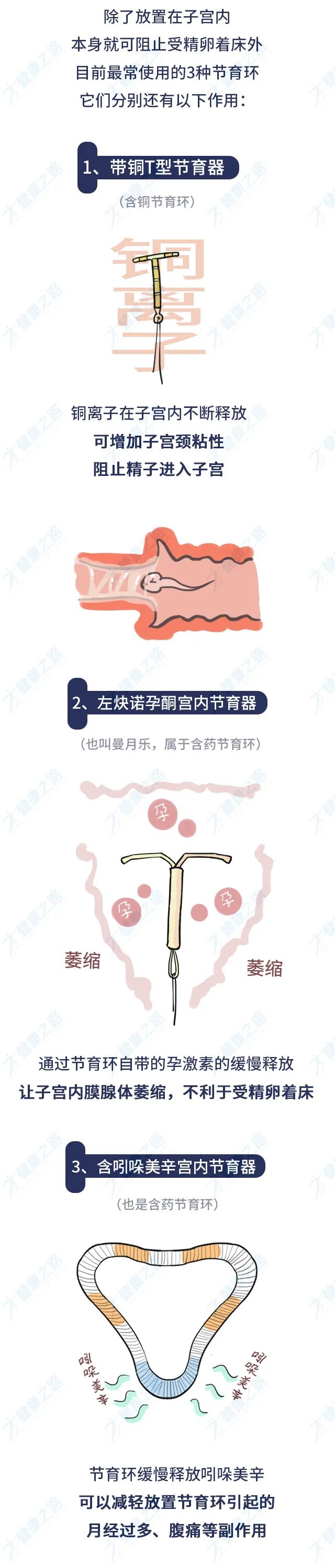 最新節育方式介紹