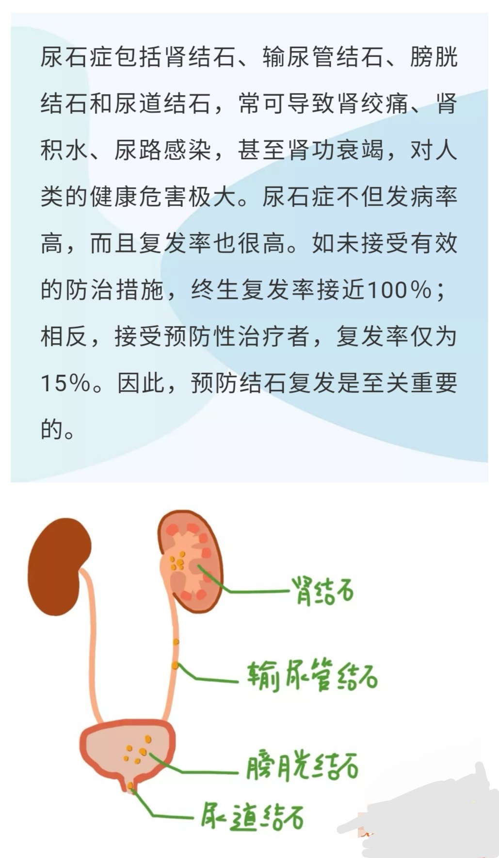 尿結石最新動態,石頭里的溫情日常關注