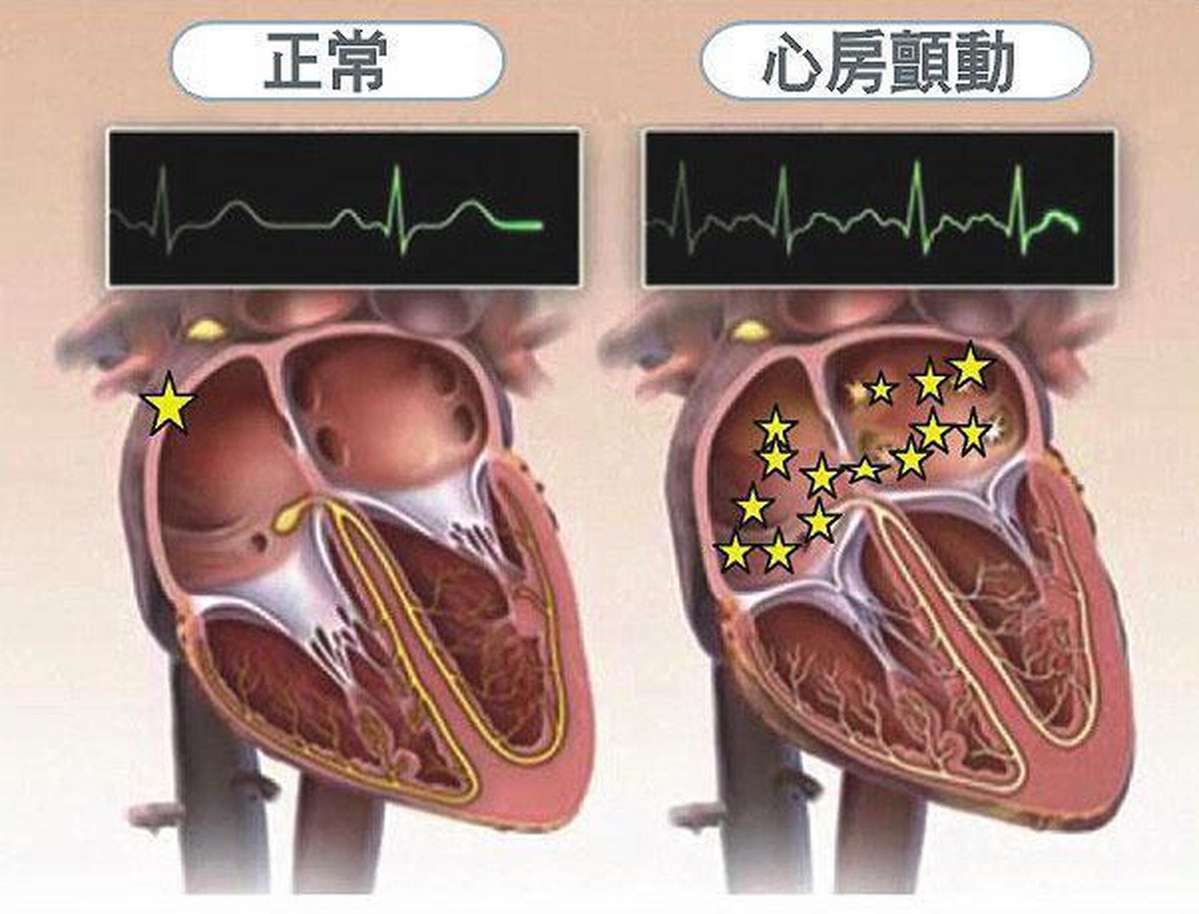 房顫吧最新資訊,全面指南助你應(yīng)對房顫挑戰(zhàn)