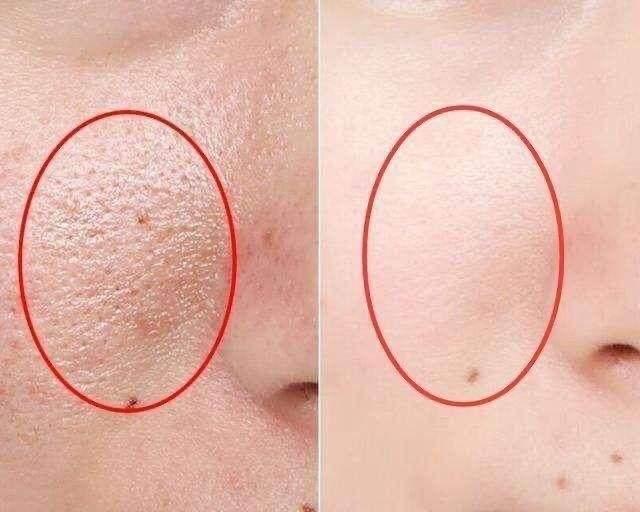 最新除皺科技，重塑自信，煥發新生力量