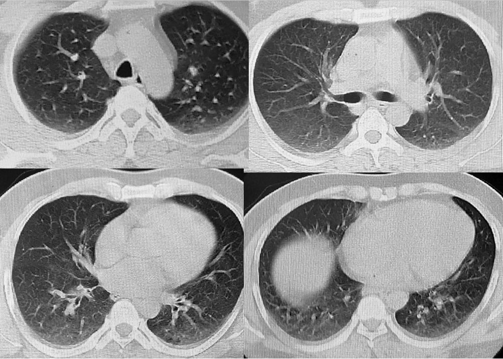 官方新冠肺炎最新動態(tài)更新，最新疫情進展與防控措施
