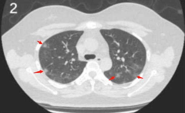 肺炎新增疫情最新情況及步驟指南,初學者與進階用戶通用